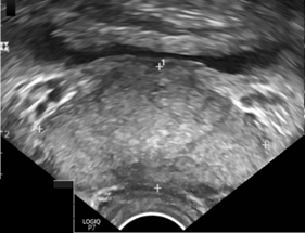 Gráfico cáncer de próstata