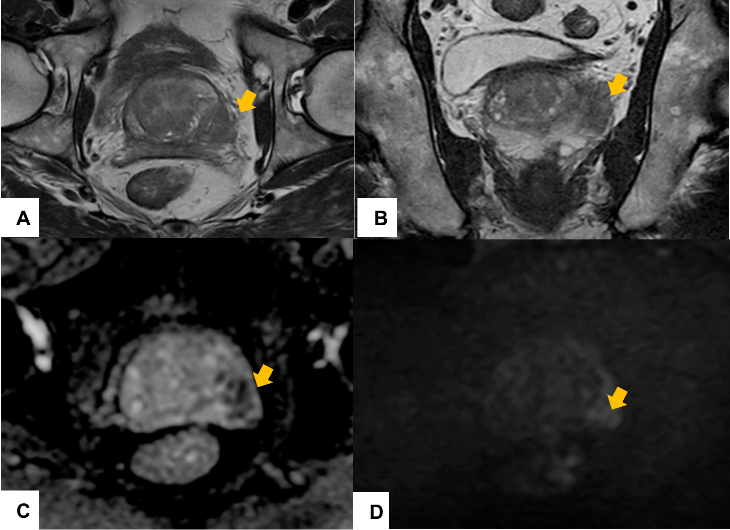 Gráfico cáncer de próstata