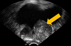 Gráfico cáncer de próstata