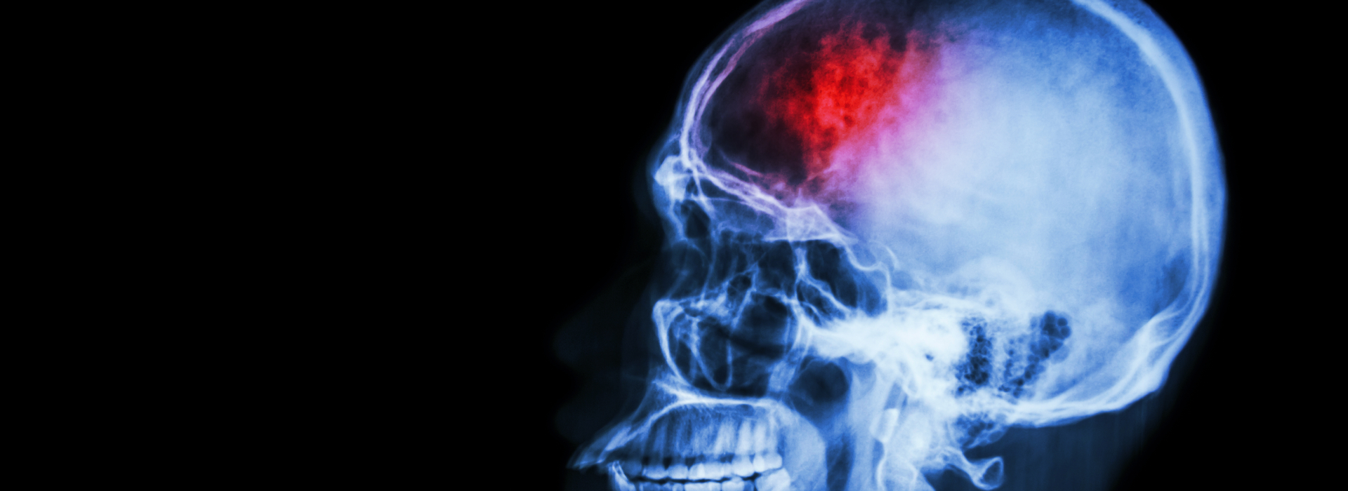 Banner de ataque cerebrovascular